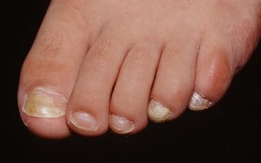 The reasons for the appearance of the fungus in the thumb