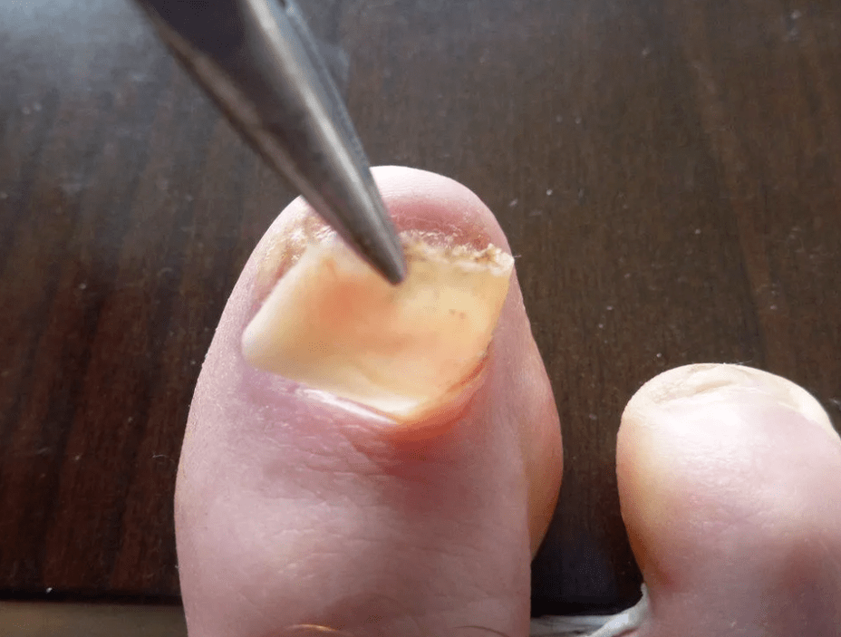 Plate Removal